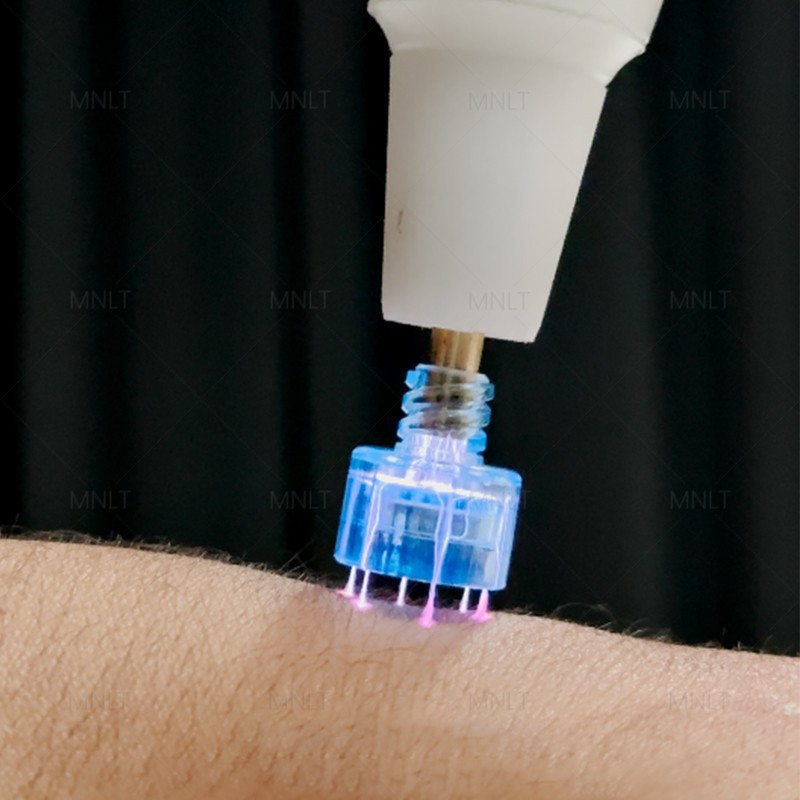 Newest Fractional Cold Plasma high quality